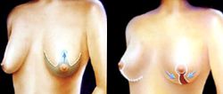 Illustration of breast lift incisions and results